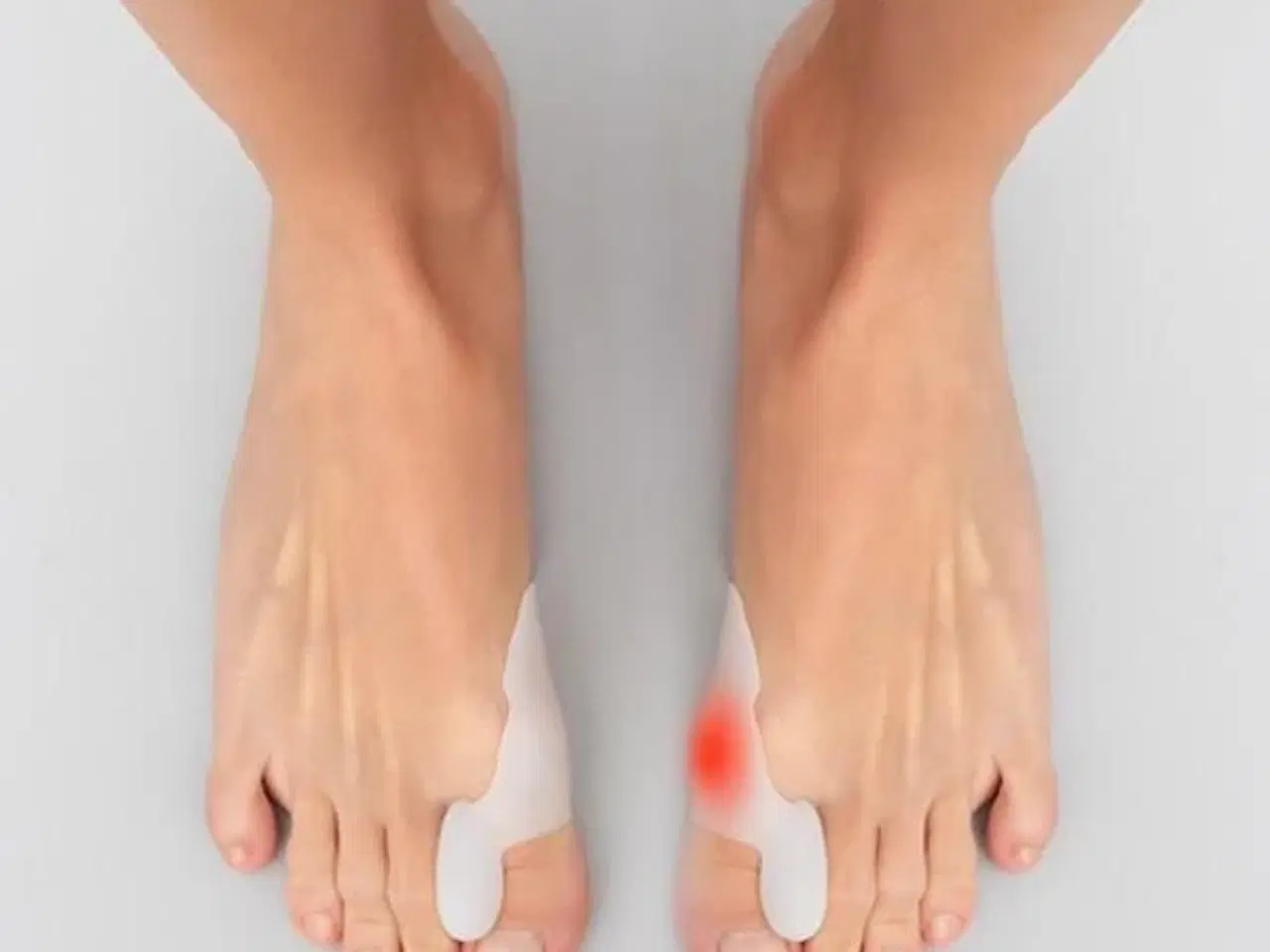 Billede 1 - Bunilief Silikone Bunion Corrector - 2 stk.