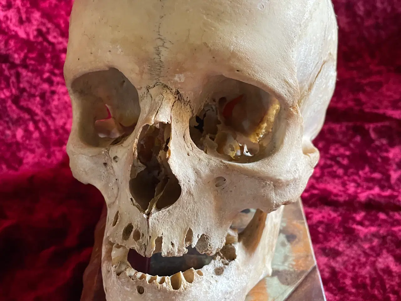 Billede 1 - Ægte menneskekranie fra gl. lægepraksis