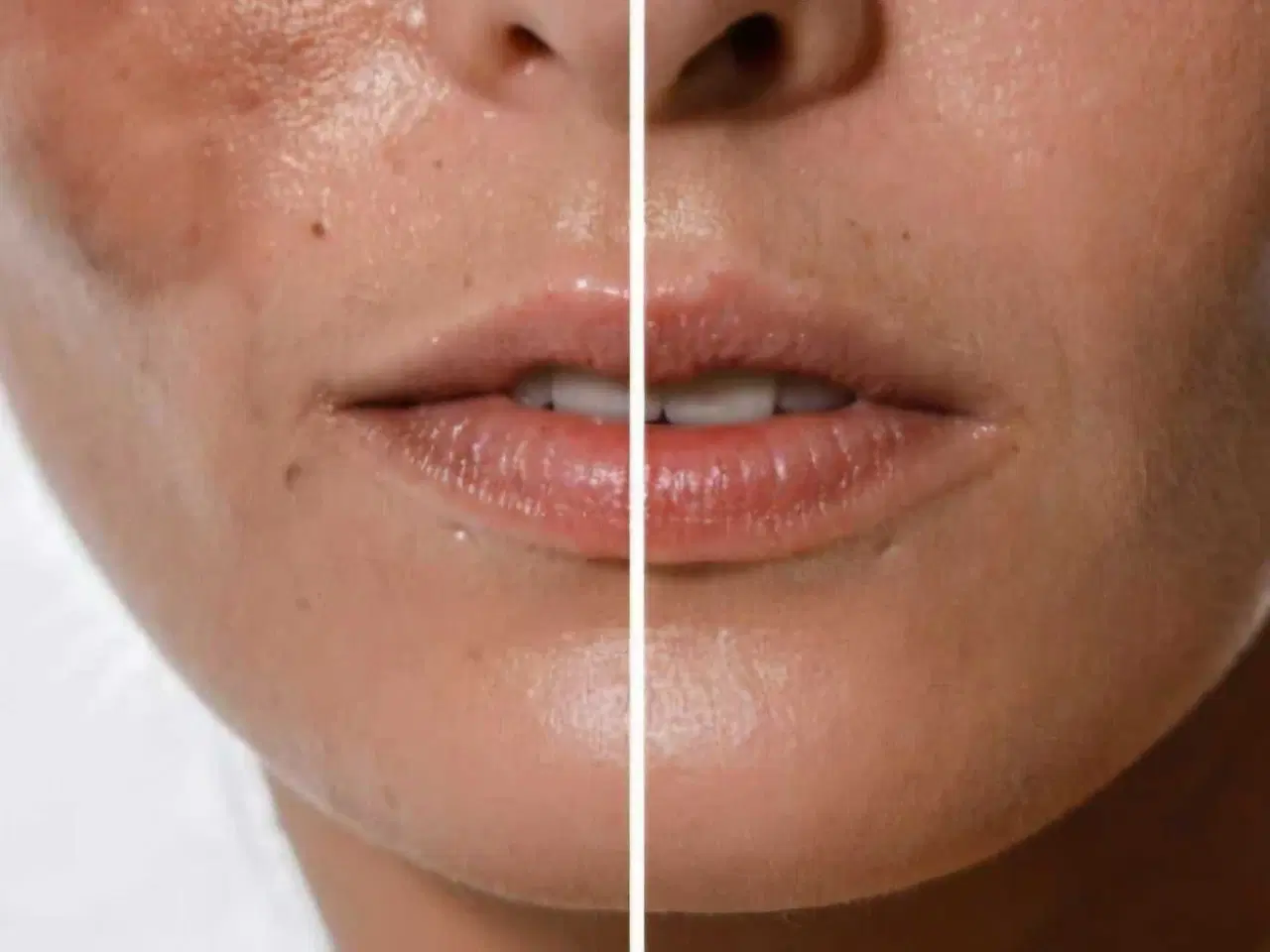 Billede 4 - Tretonoin gel 0,05%