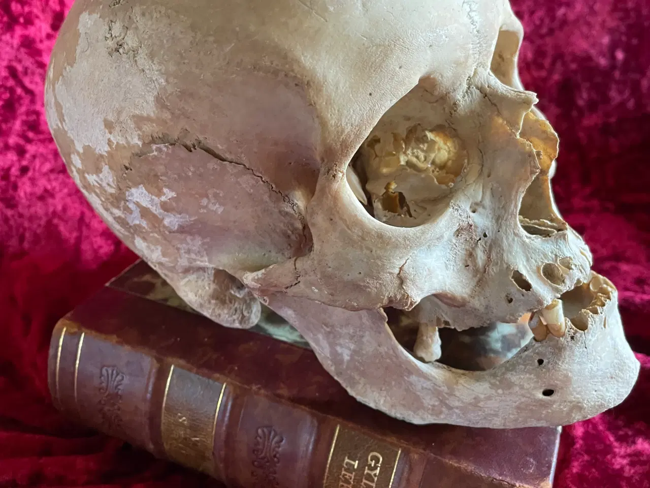 Billede 2 - Ægte menneskekranie fra gl. lægepraksis